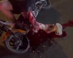Chinese woman lost her leg in a motorcycle accident