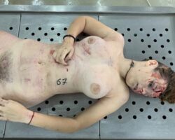 Corpse of young Russian woman on the autopsy table