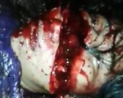 Dying woman with a slashed face and severed hand