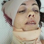 Natalia Borodina cracked head