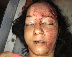 Young woman with head injury in morgue