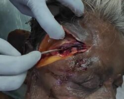 Annotated autopsy of elderly man