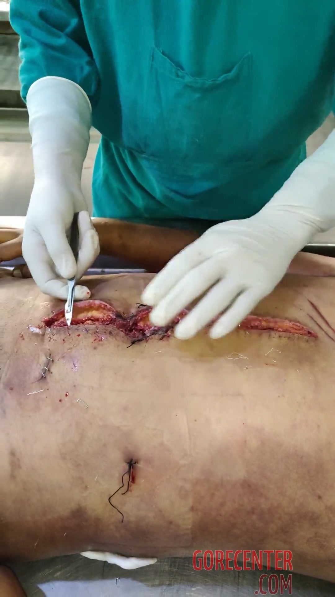 Annotated corpse reopening • GoreCenter