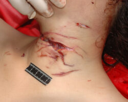 Autopsy of a Chinese woman with her throat cut