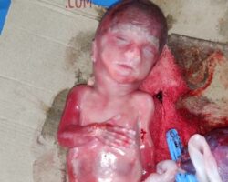 Postmortem examination of 5-month-old fetus