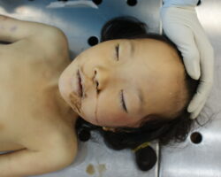Autopsy of young girl