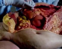 Annotated autopsy of obese woman