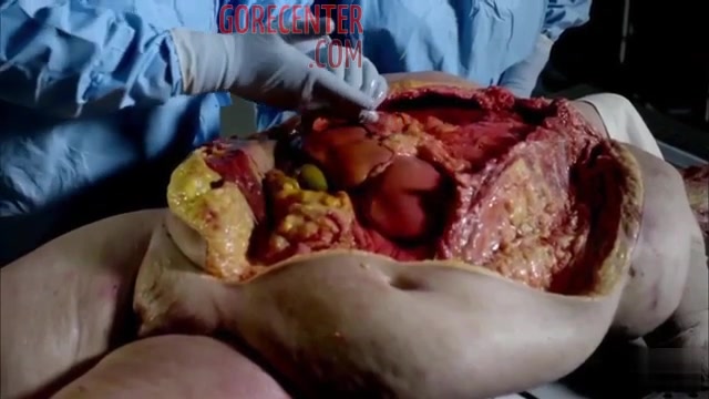 Annotated autopsy of obese woman • GoreCenter
