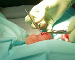 Vasectomy surgery