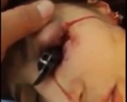 Woman with knife stuck in her eye and its removal