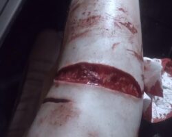 Girl cut a piece of skin off her leg and kept it