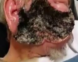 Massive face infection with maggots