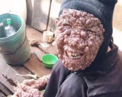 Person with serious skin condition prepares food
