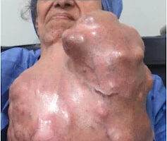 Removing cancer from woman’s neck