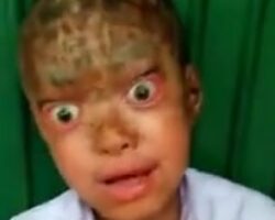 Child with rare skin disease
