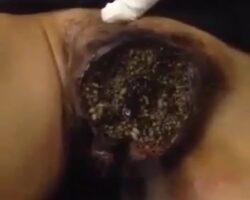 Doctors removing maggots from vagina