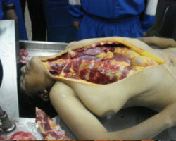 Autopsy of brazilian female