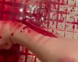 Fountain of blood from arm