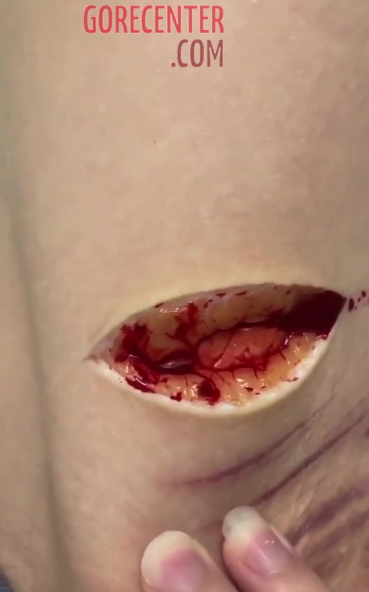 Girl cuts her leg • GoreCenter