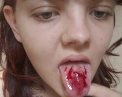 Girl cuts her tongue with razor