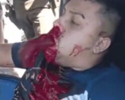 Man throwing up clots of blood after getting bullet to his face