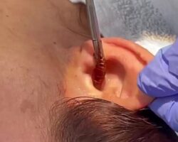 Removal of cockroach that enters the ear
