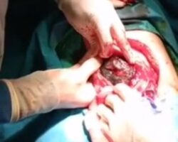 Removing hairball from 19-year-old girl’s stomach