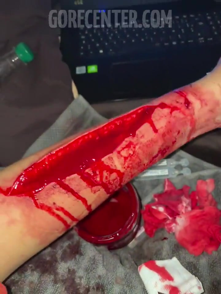 Deep cut on girl's arm • GoreCenter
