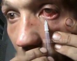 Dude injects drugs into his eye