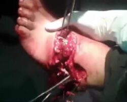 Nasty foot injury