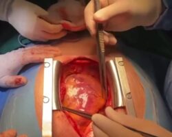 Removing pieces of shrapnel from around his heart