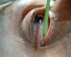 Removing tiny worms from woman's eyesockets
