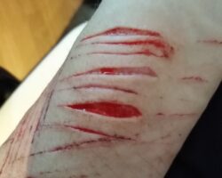 Deep cuts on the girl’s arm