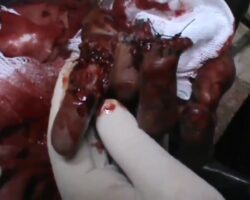 Destroyed hand with almost cut off fingers