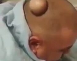 Doctor cleans cyst on patient’s head