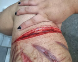 Girl cuts her thigh with razor blade