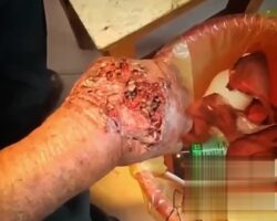 Hand infected with maggots
