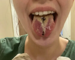 Tongue split fail