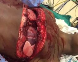 Man with his chest open has his lungs and heart exposed