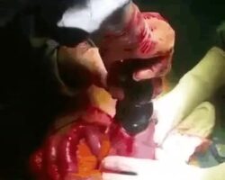 Surgically extracted large anal dildo from insides