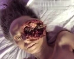 Woman is eaten alive by maggots