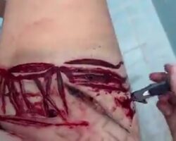 Teenage girl stabs her thigh repeatedly