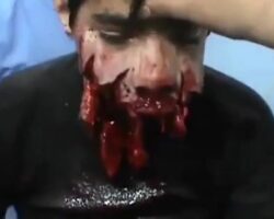 Young man lost half his face due to shelling