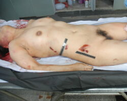Autopsy of Chinese female