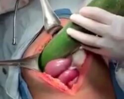 Surgeons remove a cucumber from intestines