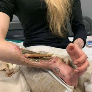 Necrosis of arm with exposed bone
