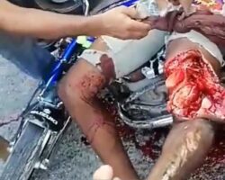 Badly injured leg after motorcycle accident