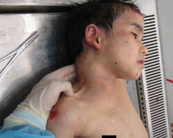 Examination of body of little Chinese girl
