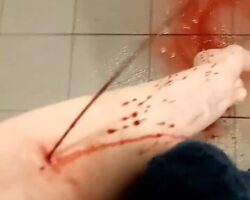 Waterfall of blood from her forearm