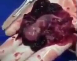 Aborted fetus is still moving